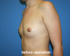 plastic-surgery-breast-augmentation